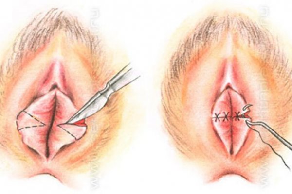 Genital Estetik Ameliyatı Gerekli Midir?