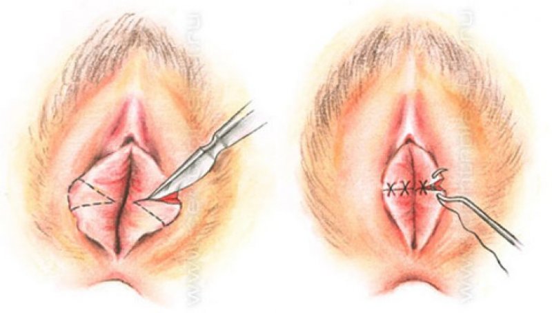 Genital Estetik Ameliyatı Gerekli Midir?
