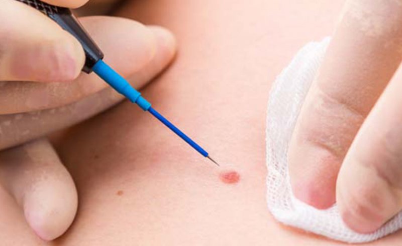 Genital Siğil Tedavisi